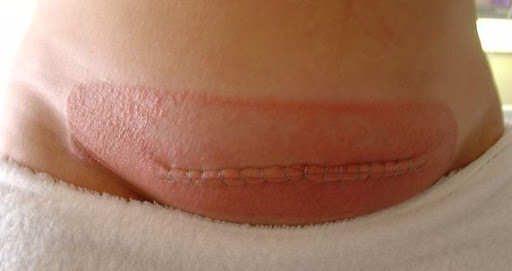 best doctor for caesarean section in ghatkopar