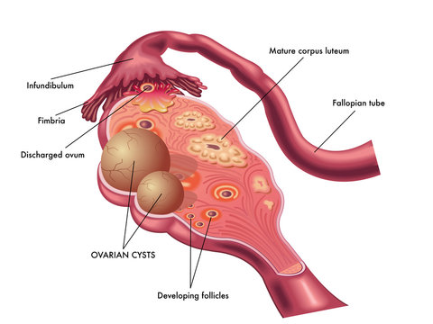 best doctor for ovarian cyst in ghatkopar
